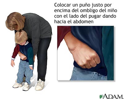 Maniobra de Heimlich en ni&ntilde;os conscientes