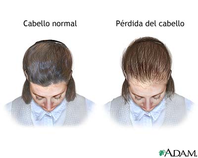 Calvicie de patr&oacute;n femenino