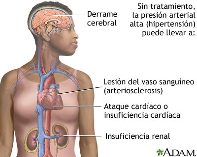 Hipertensi&oacute;n sin tratamiento