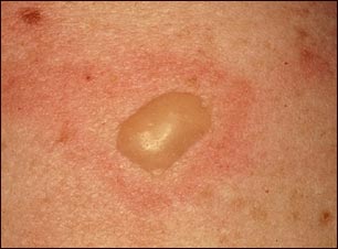 Ampolla por quemaduras vista de cerca