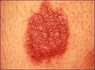 Quemadura t&eacute;rmica vista de cerca