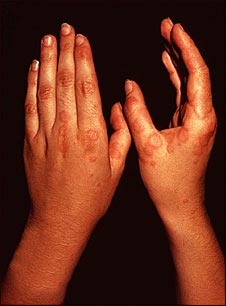 Eritema multiforme, lesiones circulares en las manos