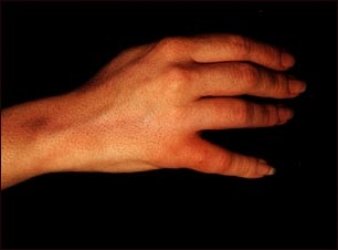 Linfangitis por estafilococos