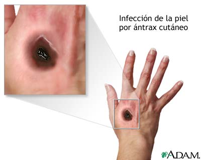 &Aacute;ntrax cut&aacute;neo