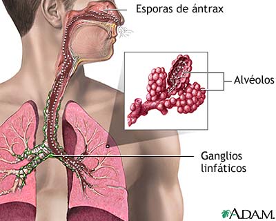 Inhalaci&oacute;n de &aacute;ntrax