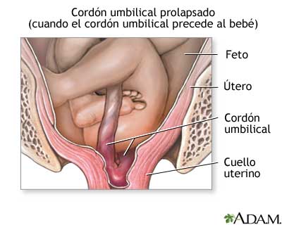 Complicaciones de la presentaci&oacute;n de nalgas
