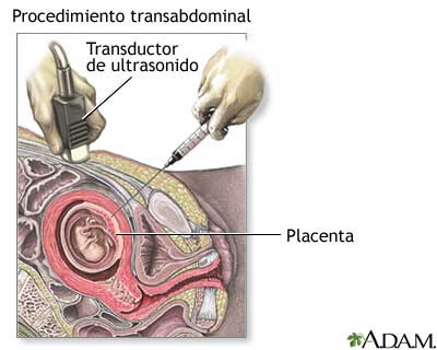 Procedimiento (segunda parte, transabdominal)