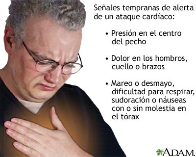 S&iacute;ntomas del ataque card&iacute;aco