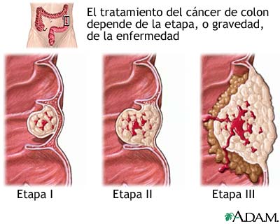 Etapas del c&aacute;ncer