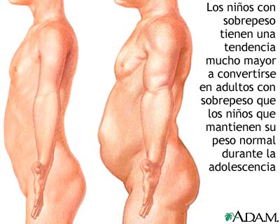 Obesidad infantil