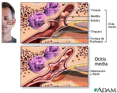 Infecci&oacute;n del o&iacute;do medio (otitis media)