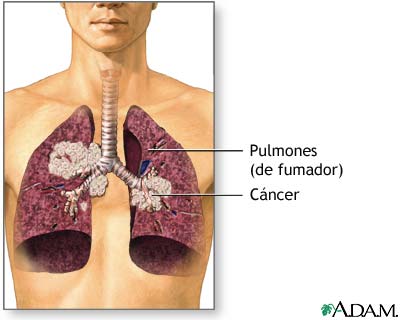 Humo de segunda mano y c&aacute;ncer de pulm&oacute;n