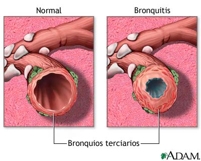 Bronquitis y condici&oacute;n normal de los bronquios terciarios