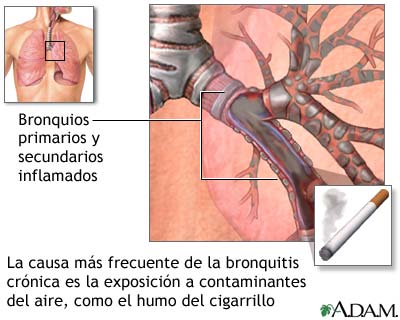 Causas de la bronquitis cr&oacute;nica