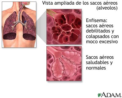 Enfermedad pulmonar obstructiva cr&oacute;nica (EPOC)
