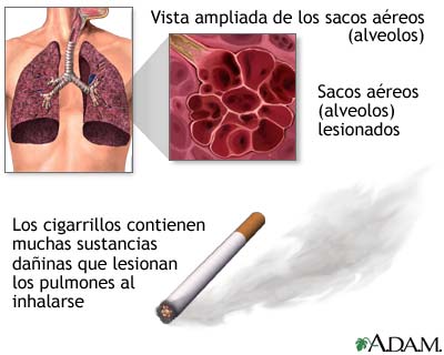 H&aacute;bito de fumar y EPOC (enfermedad pulmonar obstructiva cr&oacute;nica)