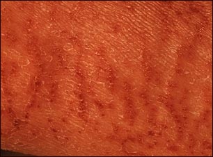 Xerosis - primer plano