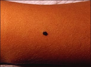 Melanoma juvenil benigno