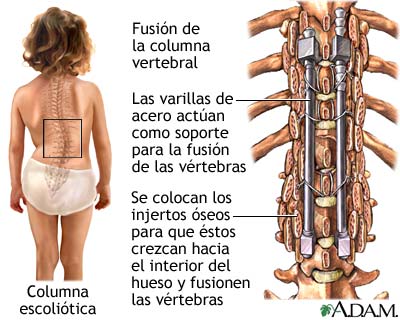 Fusi&oacute;n espinal