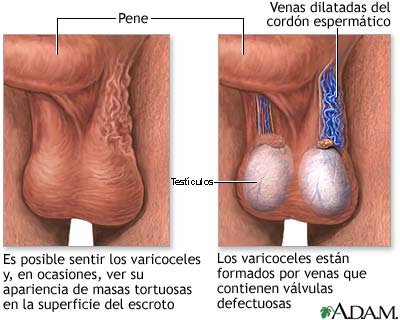 Varicocele