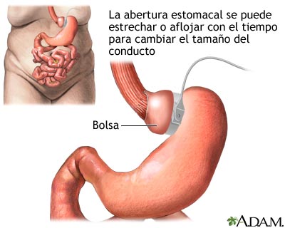 Banda g&aacute;strica ajustable