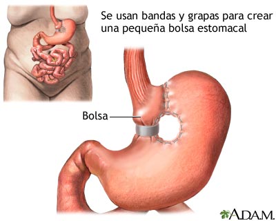Gastroplastia vertical con banda