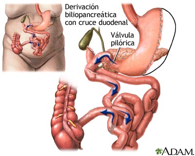 Derivaci&oacute;n biliopancre&aacute;tica con cruce duodenal