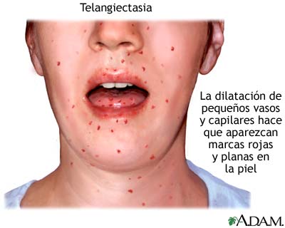 Telangiectasia