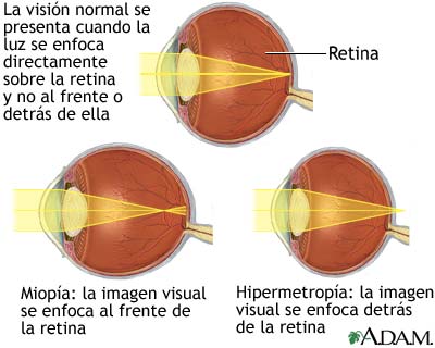 Visi&oacute;n normal, miop&iacute;a e hipermetrop&iacute;a
