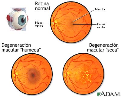 Degeneración macular