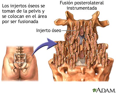 Procedimiento: fusi&oacute;n posterolateral instrumentada
