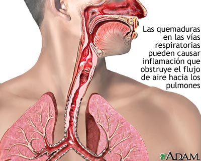 Quemadura de las v&iacute;as respiratorias