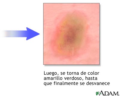 Cicatrizaci&oacute;n, parte 2