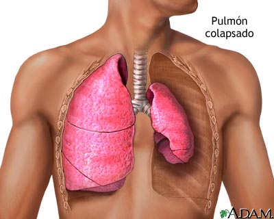 Pulm&oacute;n colapsado, neumot&oacute;rax