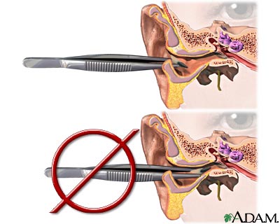 Extracci&oacute;n de objeto extra&ntilde;o