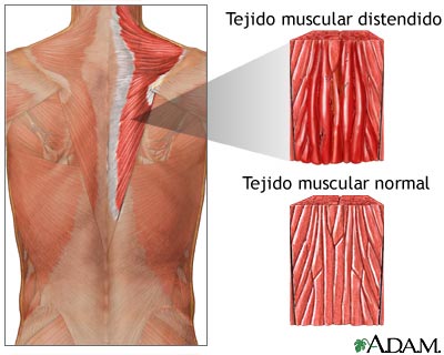 Distensi&oacute;n muscular