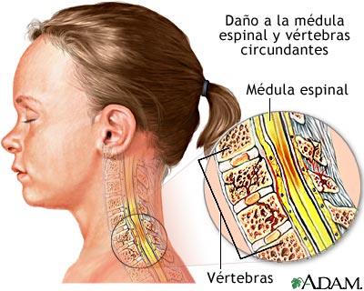 Lesi&oacute;n a la m&eacute;dula espinal