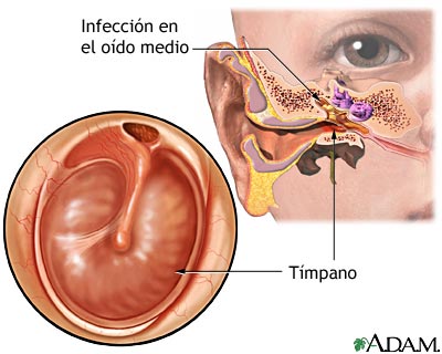 Infecci&oacute;n del o&iacute;do medio