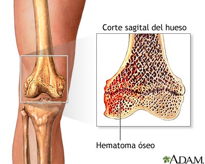 Hematoma &oacute;seo