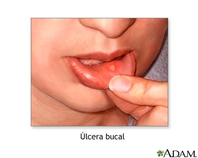 &Uacute;lceras bucales