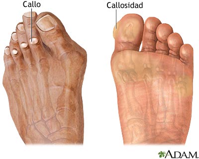 Cllosidades y callos
