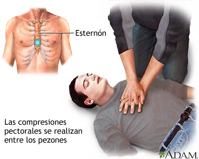 Compresiones pectorales