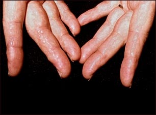 Amiloidosis en los dedos