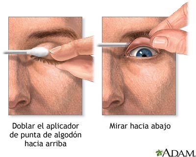 Eversi&oacute;n del p&aacute;rpado