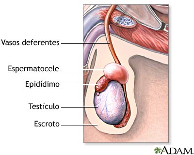 Espermatocele