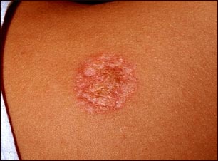 Necrobiosis lipo&iacute;dica diab&eacute;tica en el abdomen