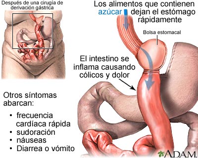 S&iacute;ndrome de evacuaci&oacute;n g&aacute;strica r&aacute;pida