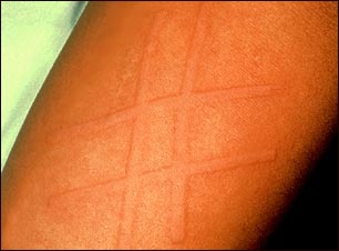 Dermatografismo del brazo