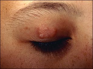 Granuloma anular en el p&aacute;rpado