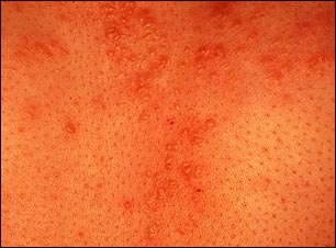 Sarcoidosis - primer plano de las lesiones de la piel